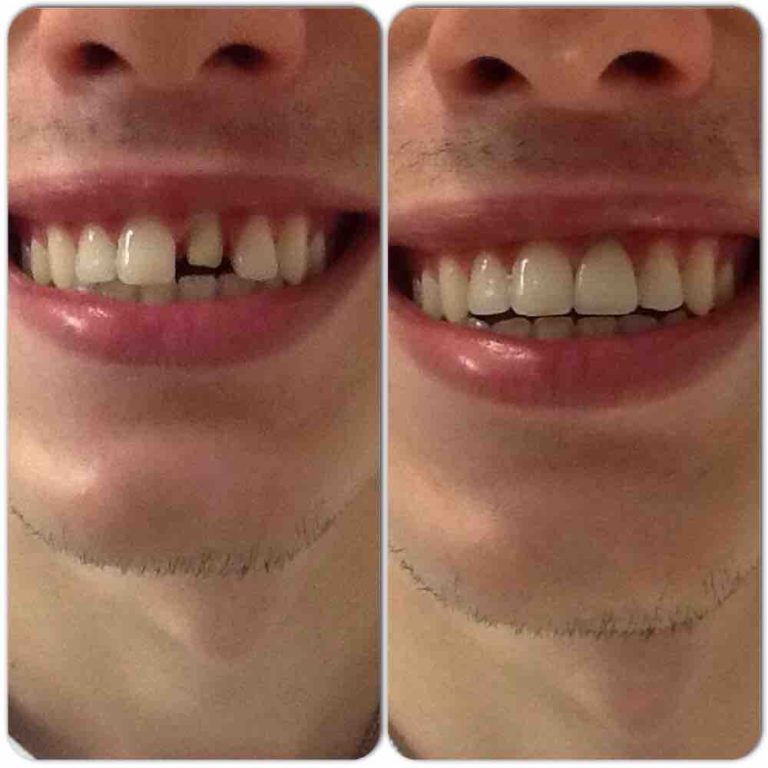 Dental Implants, Cosmetic Dentistry Center Puerto Rico Health